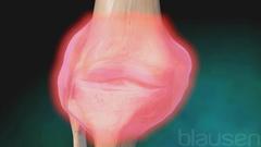 Rheumatoid Arthritis - Knee