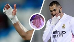 Voilà pourquoi Benzema porte constamment un bandage à la main lors des matchs