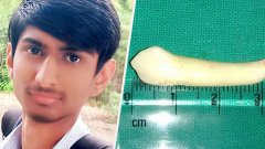 Cette étudiant s'est fait arracher ce qui pourrait être la plus longue dent du monde