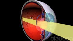 Ocular Implants