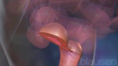 Ovariectomy