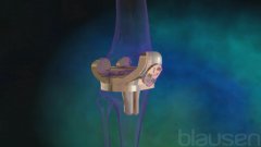 Arthroplastie du genou