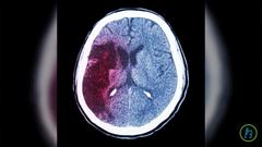 What are Strokes? FAST Facts on How to Prevent, Treat, and Manage A Stroke