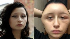 Défigurée après une coloration pour cheveux, Estelle, 19 ans, a frôlé la mort
